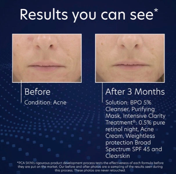 BPO 5% Cleanser